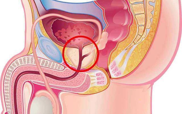 男性前列腺肥大圖片
