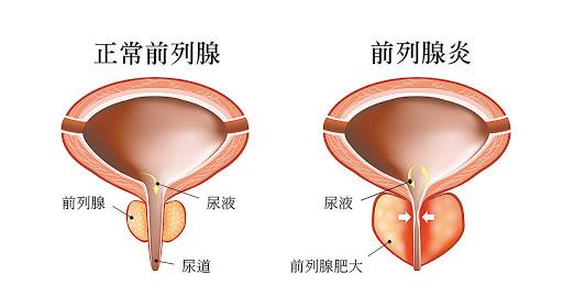 關(guān)于前列腺與性功能的關(guān)系，探究?jī)烧咧g的關(guān)聯(lián)與影響，前列腺與性功能關(guān)系探究，關(guān)聯(lián)與影響分析