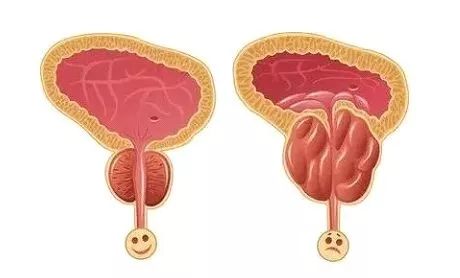 老公的前列腺增大挑戰(zhàn)，理解、支持與共同對(duì)抗，老公前列腺增大，理解、支持與共同應(yīng)對(duì)的挑戰(zhàn)