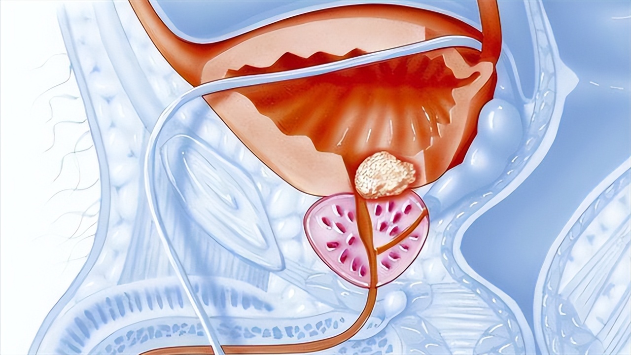 如何判斷是否得了前列腺問(wèn)題，如何判斷前列腺問(wèn)題？常見(jiàn)癥狀及檢查方法解析