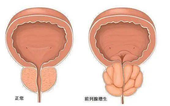 前列腺鈣化，一種常見的前列腺疾病及其相關(guān)知識解析，前列腺鈣化解析，常見疾病與相關(guān)知識探討