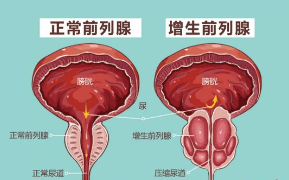 前列腺增生大小標(biāo)準(zhǔn)，理解其關(guān)鍵要素與影響，前列腺增生大小標(biāo)準(zhǔn)詳解，關(guān)鍵要素與影響因素解析