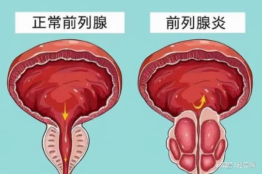 男性前列腺炎的癥狀解析，男性前列腺炎的癥狀詳解