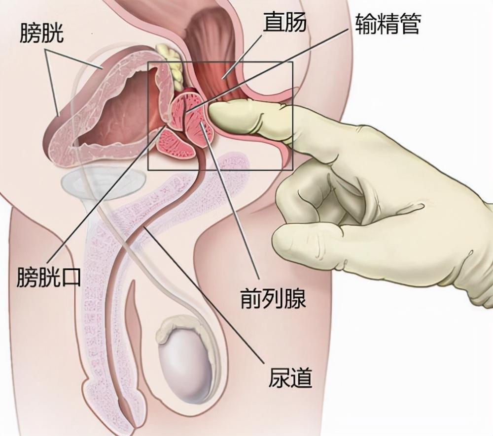 前列腺炎根本不是病