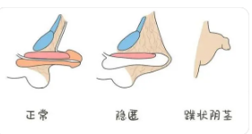 關于做包皮手術的費用分析，包皮手術費用詳解