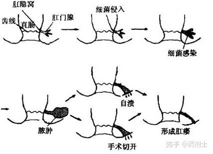 關(guān)于我才17歲陽(yáng)瘺會(huì)自己恢復(fù)嗎的一些探討，關(guān)于17歲陽(yáng)瘺是否會(huì)自行恢復(fù)的探討