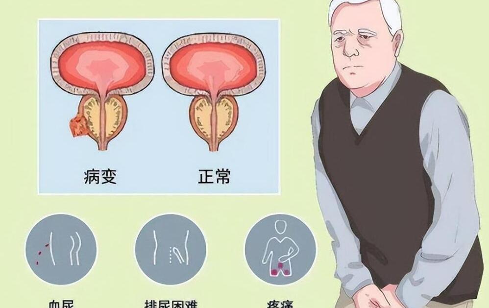 年輕人得了前列腺增大，理解、應對與關注，年輕人前列腺增大，理解、應對與關注的重要性