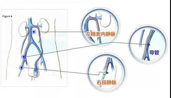 右邊睪丸隱痛會(huì)自愈嗎？解析原因與應(yīng)對(duì)之道，右邊睪丸隱痛，原因解析與自愈可能性探討