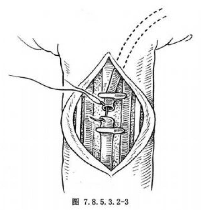 陽(yáng)瘺的最佳治療方法，中藥的獨(dú)到之處，陽(yáng)瘺最佳治療方法，中藥獨(dú)到之處的探索與實(shí)踐