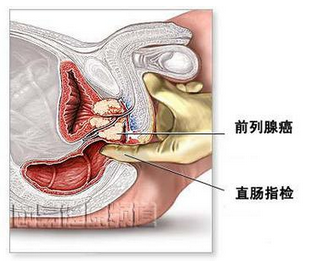 根治前列腺疾病的最佳中藥偏方，探尋古老智慧的新希望，古老智慧新希望，最佳中藥偏方根治前列腺疾病