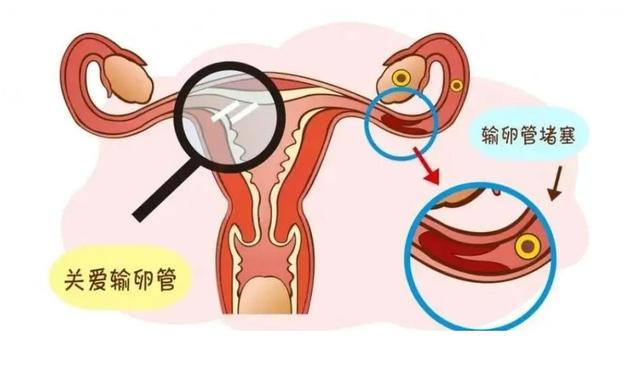 輸卵管堵塞的癥狀表現(xiàn)與解析，輸卵管堵塞的癥狀、表現(xiàn)與解析