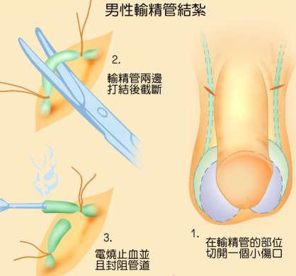 為什么醫(yī)院不提倡男性結(jié)扎，探究背后的原因與考量，探究醫(yī)院不提倡男性結(jié)扎的背后原因與考量