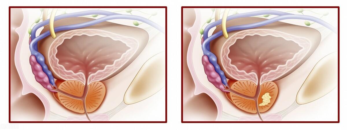 前列腺鈣化，揭示其潛在危害，前列腺鈣化，潛在危害揭秘