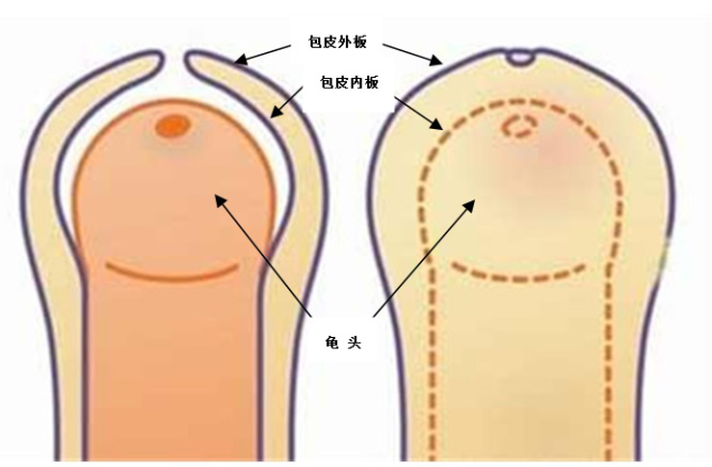 包莖及其相關圖片，了解、識別與處理，包莖詳解，圖片、識別、處理方法全攻略