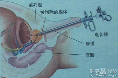 如何控制前列腺增生，如何控制前列腺增生的發(fā)展及癥狀？