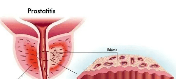 怎么調(diào)理前列腺炎