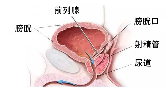 前列腺炎治療療程與效果深度解析