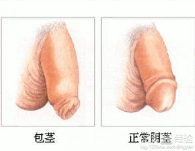 包莖過長(zhǎng)對(duì)身體的影響及應(yīng)對(duì)措施，包莖過長(zhǎng)對(duì)身體的影響與應(yīng)對(duì)措施解析