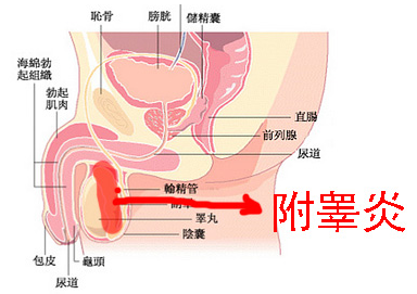 附睪炎，絕望中的希望曙光，附睪炎，絕望中的希望之光