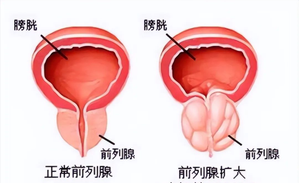 前列腺疾病的癥狀