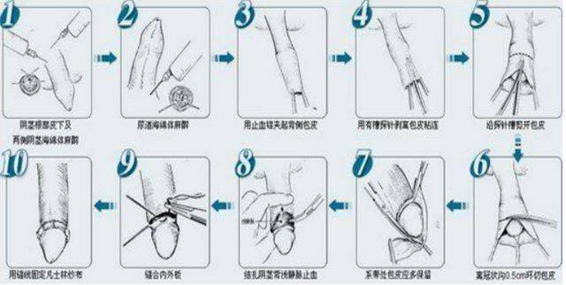 大人環(huán)切手術(shù)后的恢復(fù)圖及其相關(guān)解析，大人環(huán)切手術(shù)后的恢復(fù)圖詳解與解析