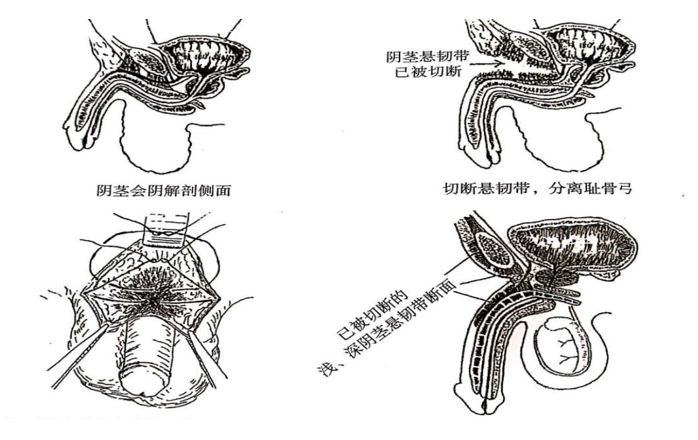 男性增大手術(shù)